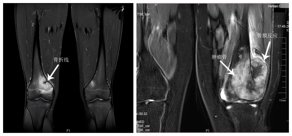 发现典型的骨折线,恶性骨肿瘤存在诸如皮质骨破坏,瘤骨形成,"codman三