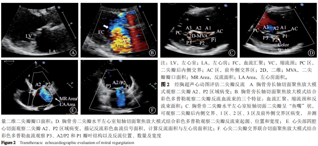 专家共识丨中国经导管二尖瓣缘对缘修复术临床途径（2022版）精简版