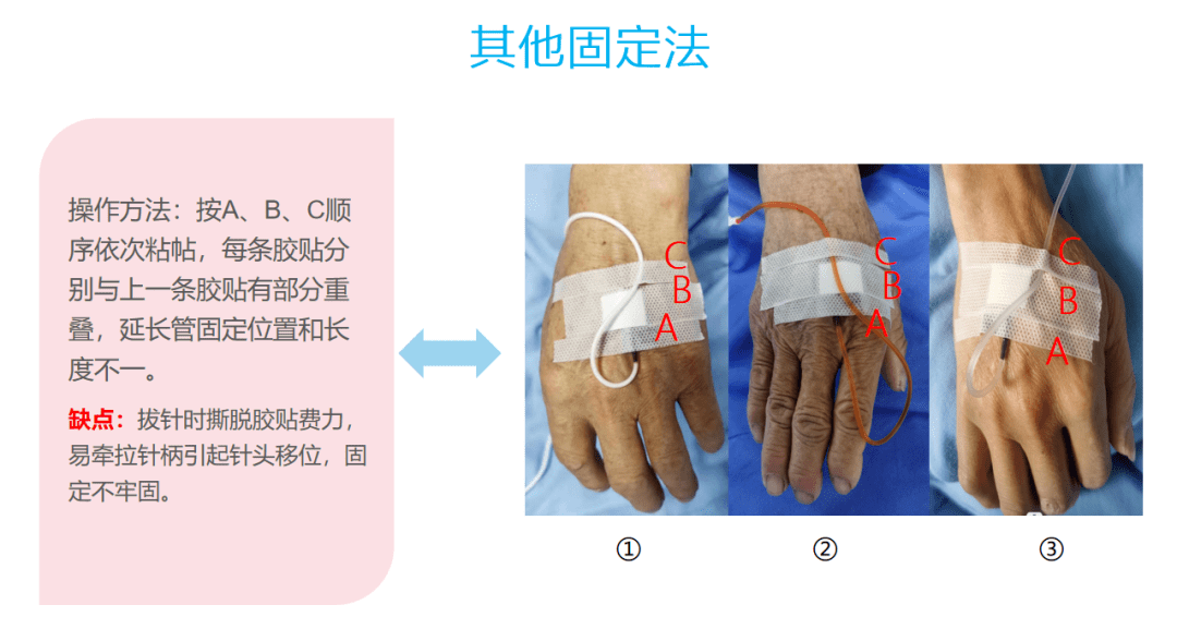 输液胶布固定方法图片图片