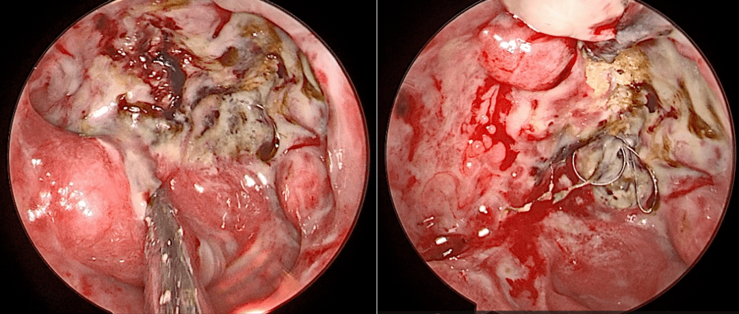 环湖手术前沿 | 一例鼻咽癌放疗后颅底传染坏死的高难度双镜结合手术 - 佟小光 刘钢 冯国栋 张金玲 翟翔等