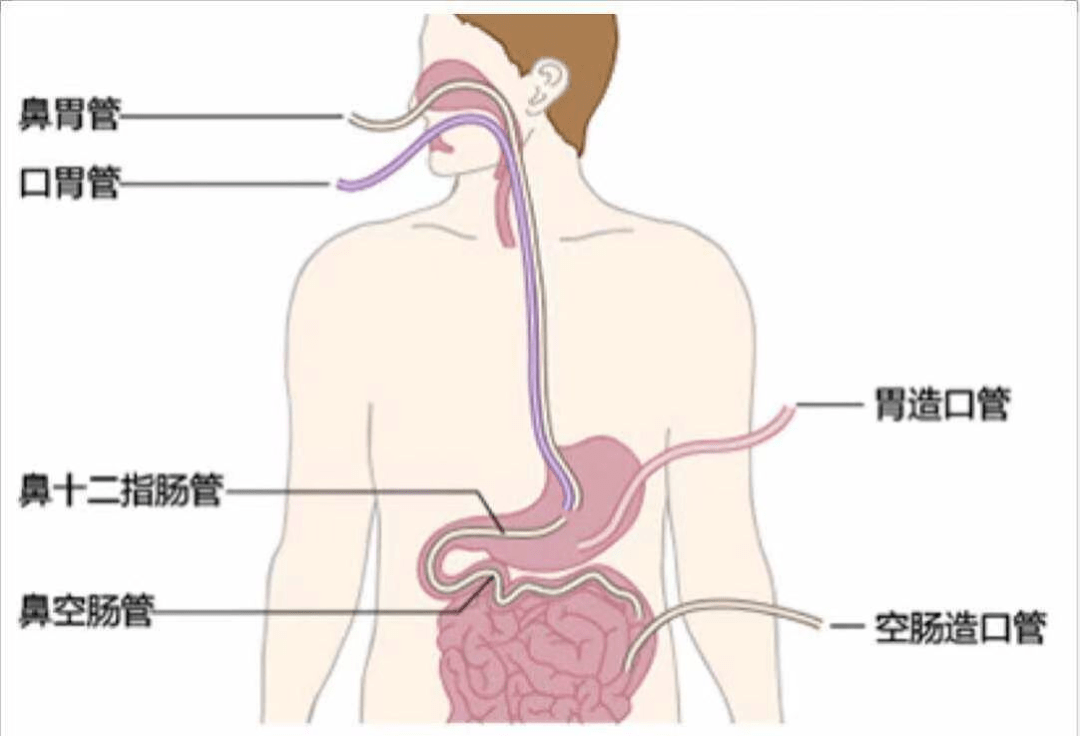 在置管过程中协助医生快速引导鼻肠管通过幽门进入十二指肠相应的位置