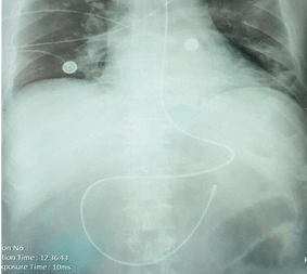 碰到棘手的鼻肠管不会插?那是你没学会这个"绝技"_导管_患者_气流