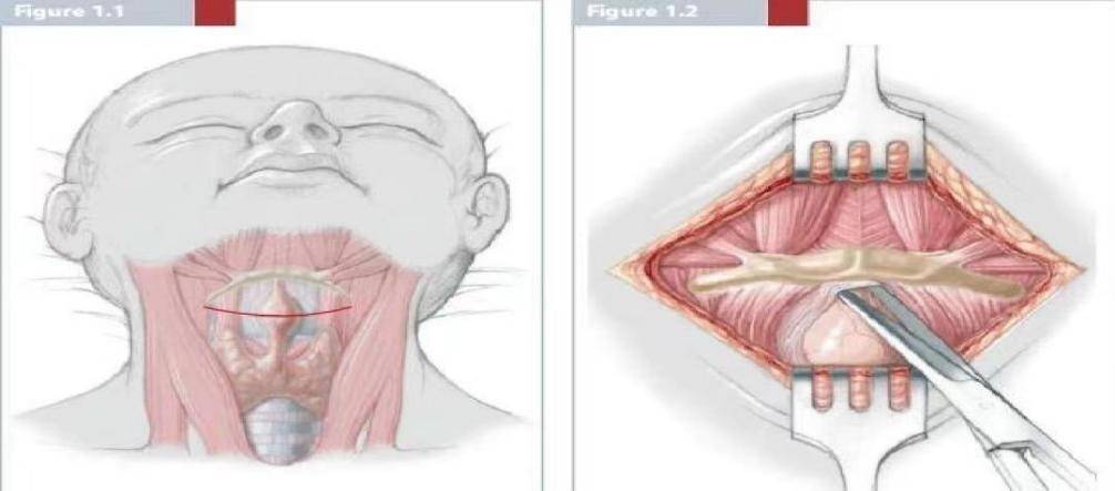 舌骨囊肿有什么症状图片