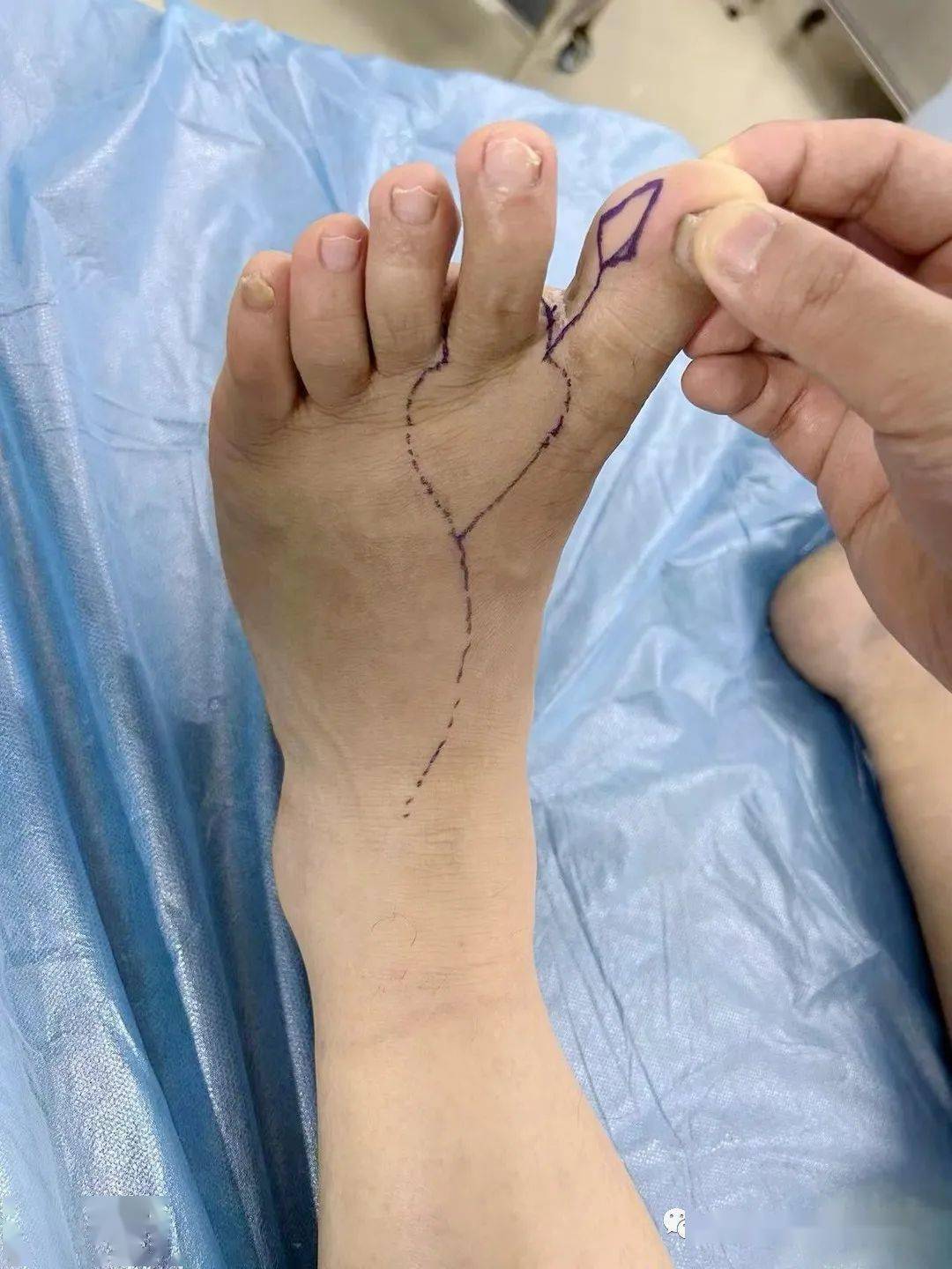 神奇!把脚趾移植到手上,这画面不敢想象
