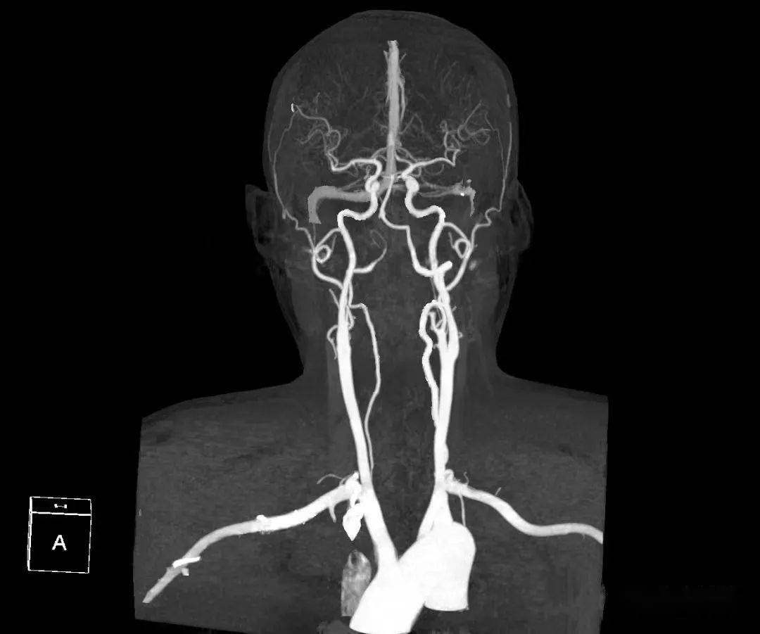头颈部血管cta图片