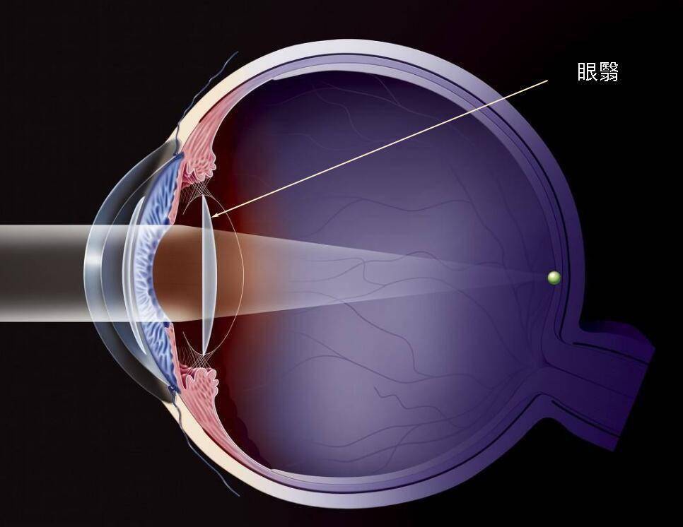 (4)眼球上所生障蔽视线的膜.如:白翳;翳子.