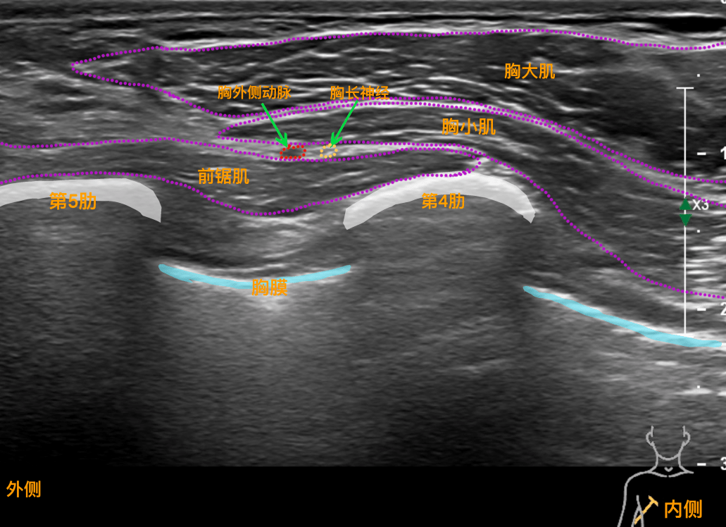 前锯肌神经阻滞超声图图片