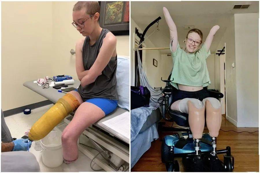 美国女子爆败血症昏迷16天,四肢坏死截肢