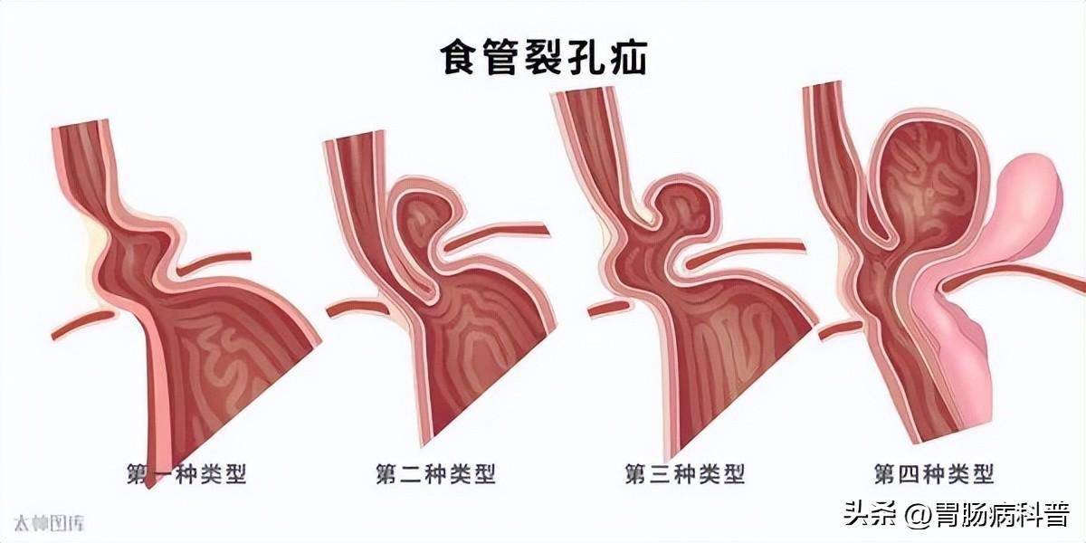 食管裂孔疝分型图片图片