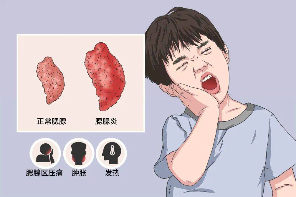 性腮腺炎病毒引起的一种急性病毒性传染病,主要发生在1~15岁的儿童和