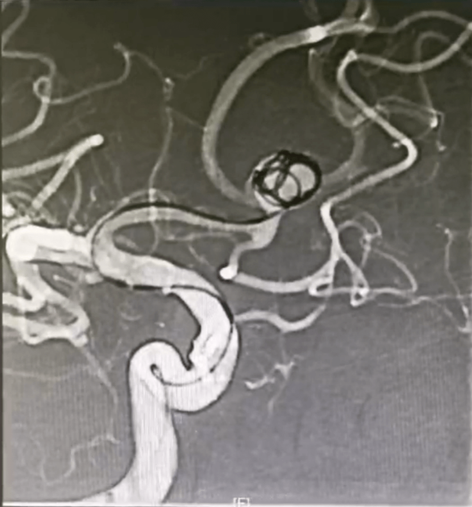 Esperance为弹簧圈栓塞术建立稳定通路，治疗前交通破裂动脉瘤一例 导管 患者 手术