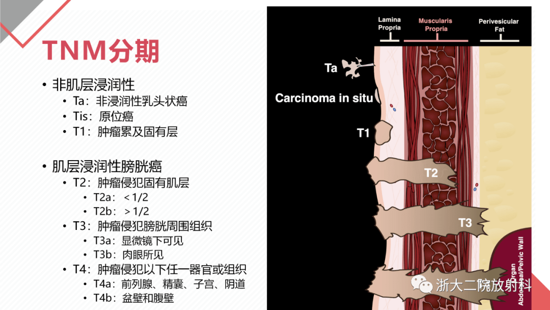 膀胱原位癌图片