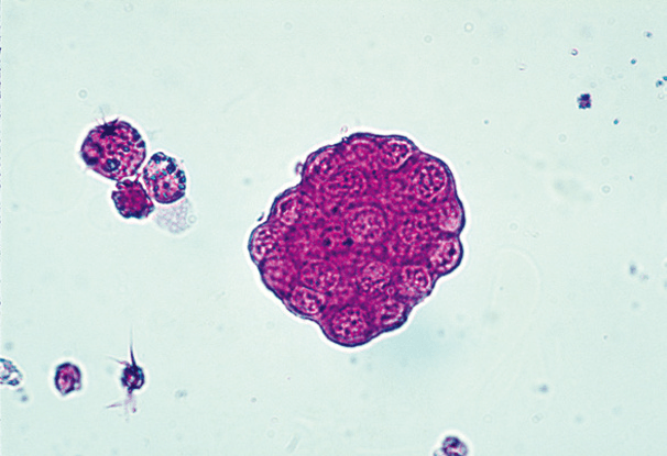 最新资料整理的尿检图谱:33张图片展示尿液中的上皮细胞_chew_来自
