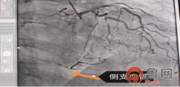 冠脉闭塞病变逆向支架植入_血管_导管室_造影