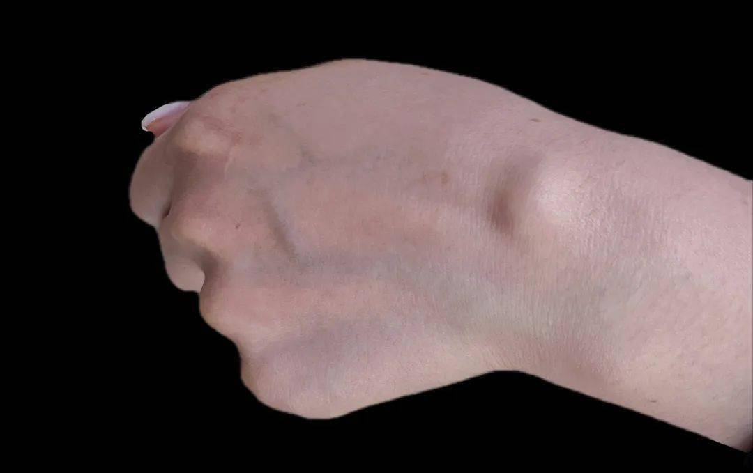 "益生军"来了丨腱鞘炎,腱鞘囊肿都是玩手机惹的祸?_手腕_手指_肌腱