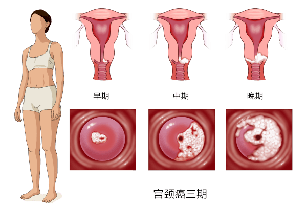 宫颈组织学分层示意图图片