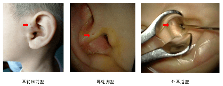 宝宝耳朵旁有这种小洞?小心,别乱碰_分泌物_孩子_护理