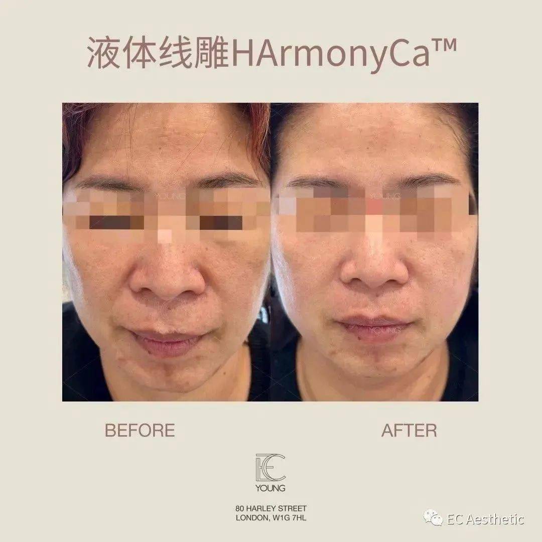内娱女明星颜值扎堆回春,原来秘密是这个!_轮廓_harmonyca_面部