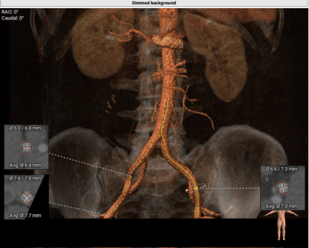 突破"阻"碍|四川大学华西广安医院文俊杰教授团队成功