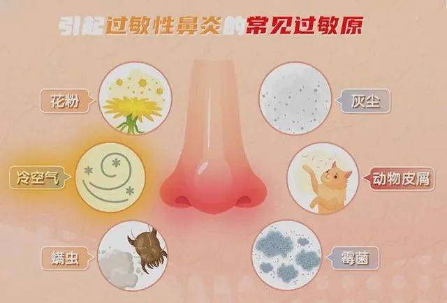 过敏性鼻炎传染吗 来自搜狐网