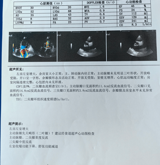 超声提示:主动脉瓣,二尖瓣重度返流,三尖瓣中度返流