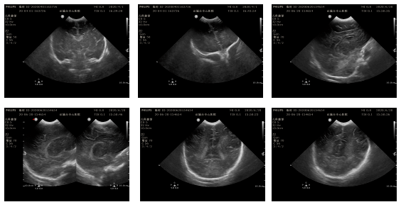 「 小儿颅脑超声」之新生儿脑实质出血