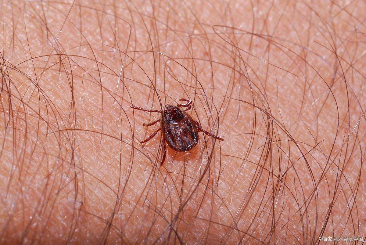 眼睛瘙痒难耐，医生从睫毛中夹出18只阴虱！是怎么染上的？_传播_生理_疾病