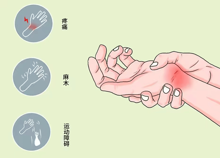 大道至简 —— 针刀疗法治疗腕管综合征 快速,精准
