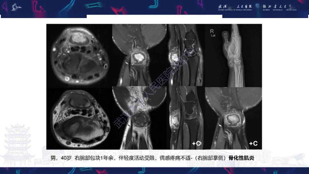 骨化性肌炎影像图片图片