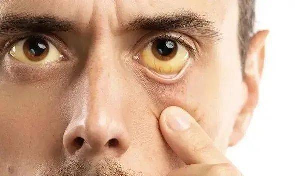 胆红素指标变化过程中会引发黄疸,黄疸主要特点是让患者皮肤颜色萎黄