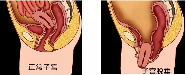 盆腔脏器脱垂既往此类患者多行经阴道子宫切除及阴道壁修补术,而未