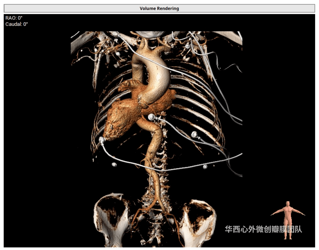 全球首例!华西医院郭应强教授团队成功完成一例镜面右位心球扩tavr