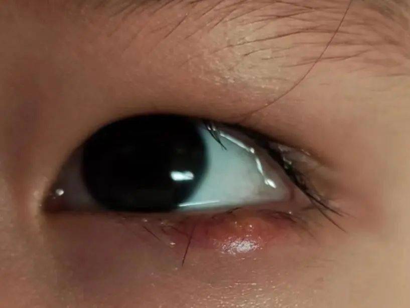 eyenurse科普揭开霰粒肿手术的神秘面纱