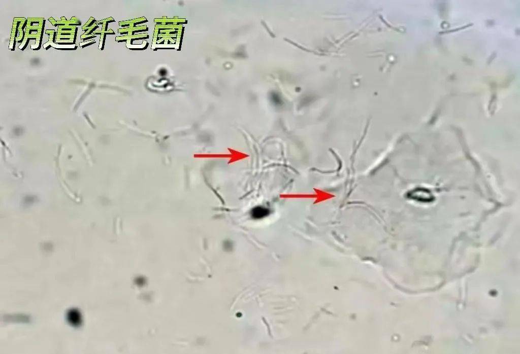加德纳菌阳性白带图片图片
