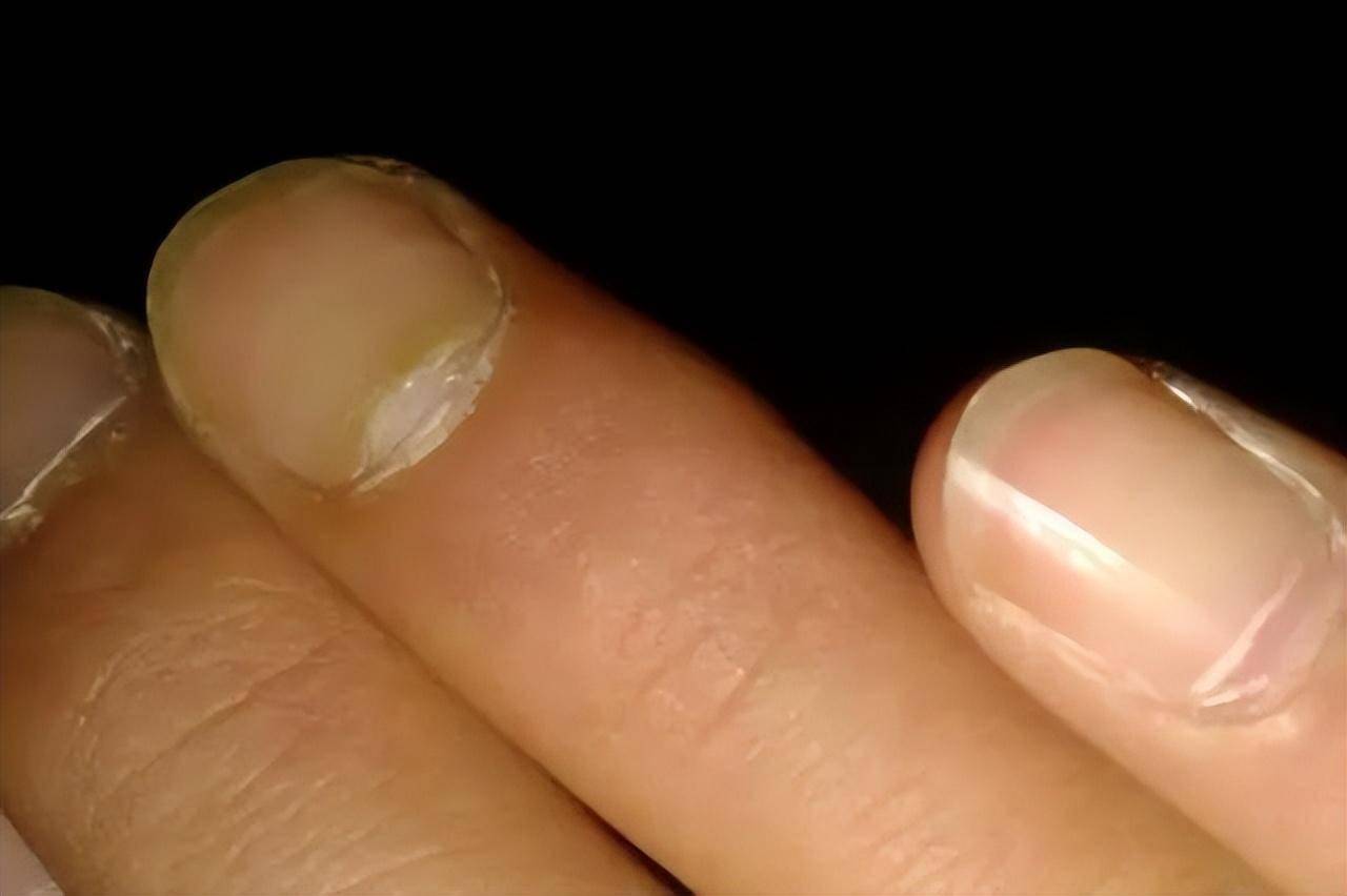 为何指甲上有竖纹?