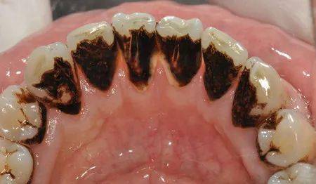 ▼如果这种斑块突出于牙齿表面,那么很有可能是牙结石