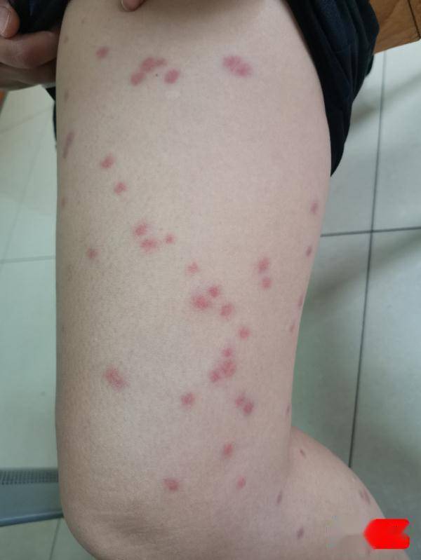痒得睡不好,误以为是湿疹发作,其实是得了丘疹性荨麻疹