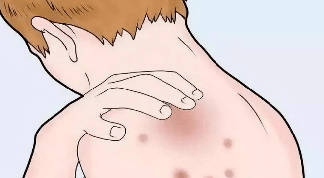 一,湿疹症状湿疹症状主要表现为皮肤的干燥,红肿,起疙瘩,瘙痒和破皮等