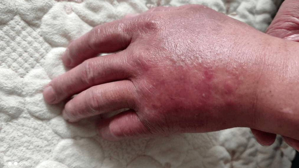 创面_左手_治疗