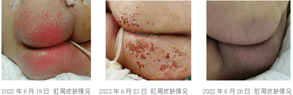 失禁性皮炎这样护理,效果立竿见影!_患者_皮肤_治疗