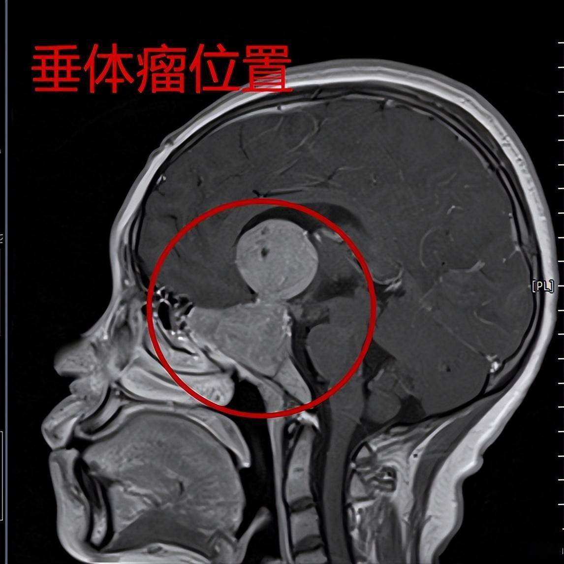 垂体瘤在头部位置图片图片