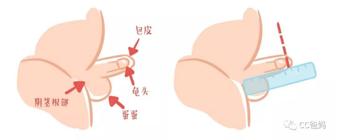 家有男宝，关于小鸡鸡的这些事一定要提前了解，尤其是这2种，早发现早干预！