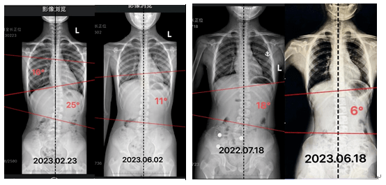 我们筛查了萧山2万多名中小学生,不少孩子这个指标呈