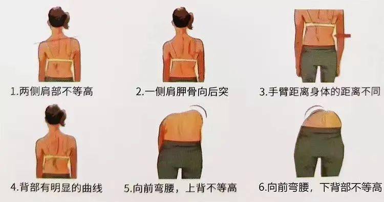 我们筛查了萧山2万多名中小学生,不少孩子这个指标呈"阳性"_脊柱_治疗