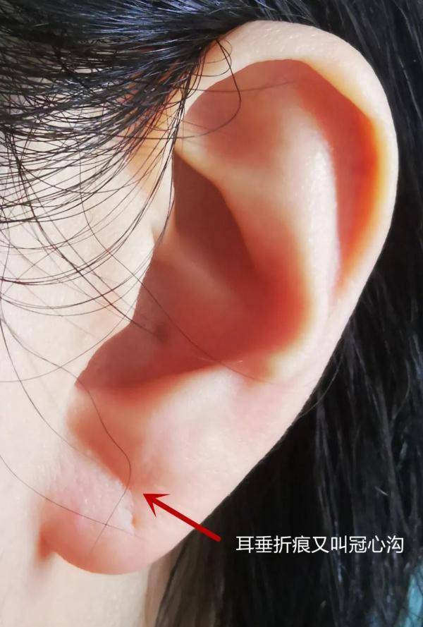 耳垂折痕的真实说法图片