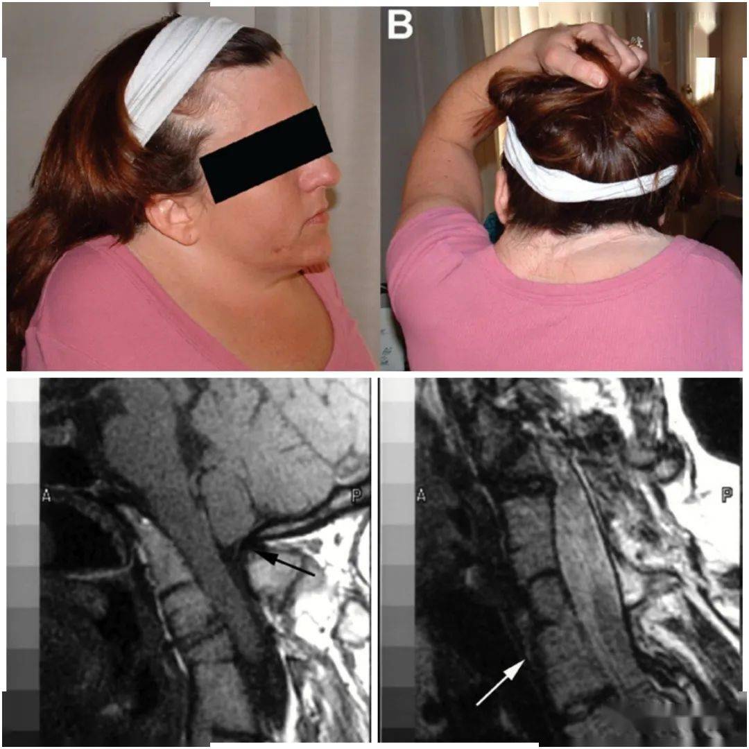 患有klippel-feil综合征的人除了脊柱异常外,还可能有多种其他特征.