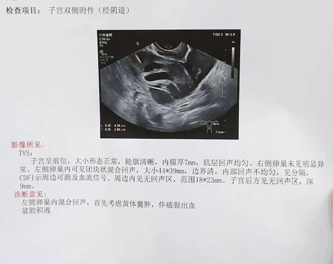 后说道:"患者存在左侧卵巢内混合回声,首先考虑黄体囊肿伴破裂出血