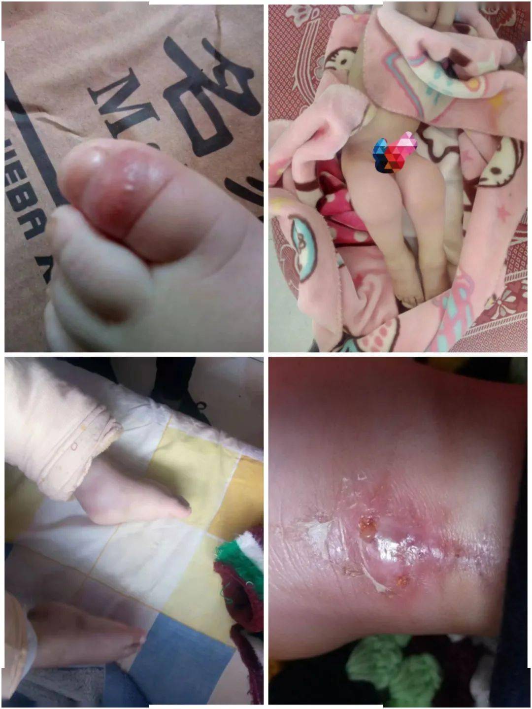 宣威8岁小女孩身患全球罕见病,请看到的老乡伸出援助之手,谢谢!