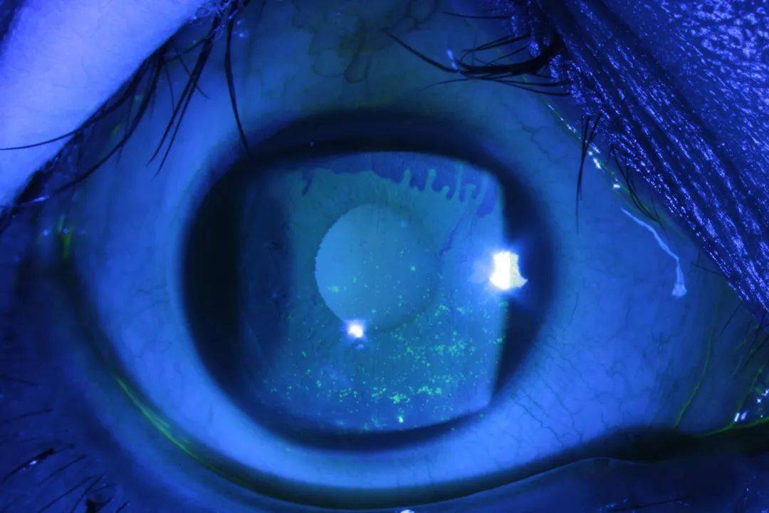 角膜表面若存在绿色的点状着色,说明眼表已经发生了损伤,代表干眼的