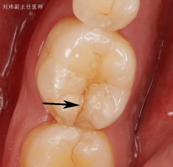 牙龈炎症状图片裂开图片